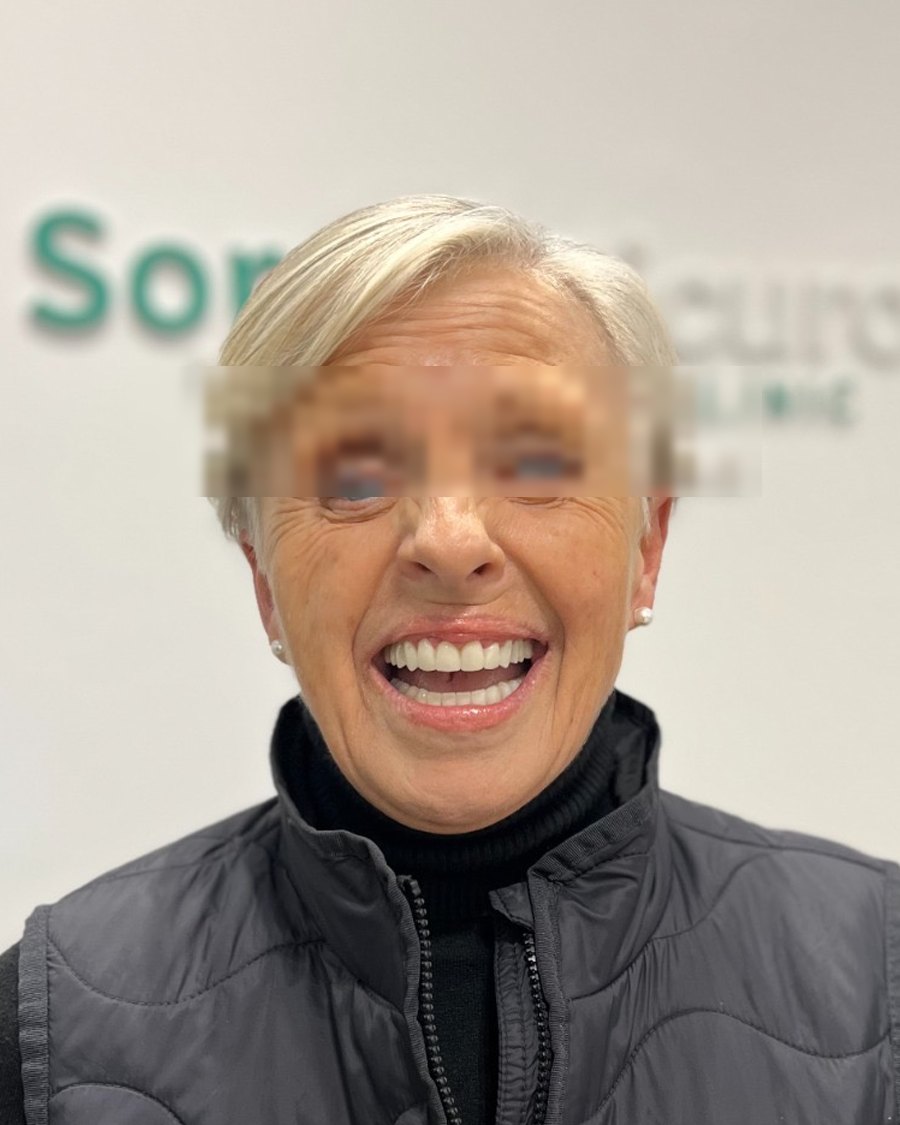 Barbara W. after treatment - Sorriso Sicuro