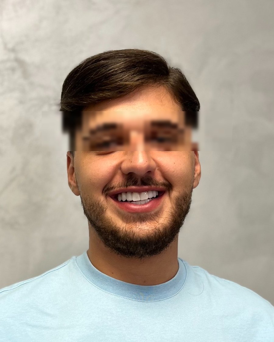 Giovanni I. after treatment - Sorriso Sicuro