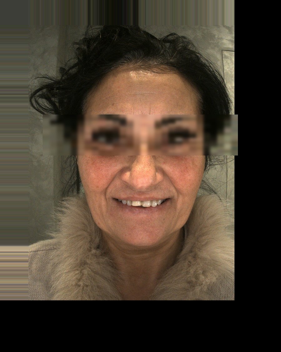 Rossana B. before treatment - Sorriso Sicuro