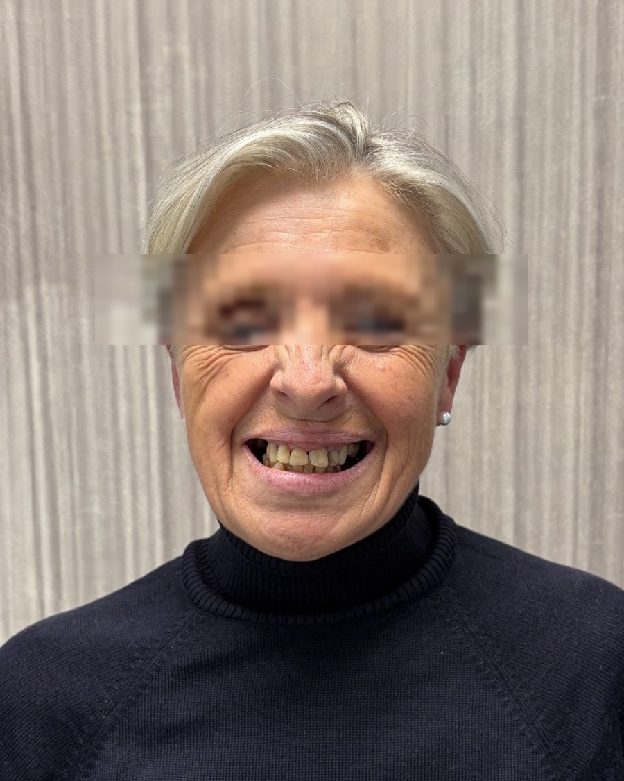 Barbara W. prima del trattamento - Sorriso Sicuro