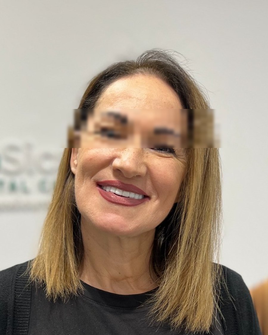 Giuseppa G. dopo il trattamento - Sorriso Sicuro