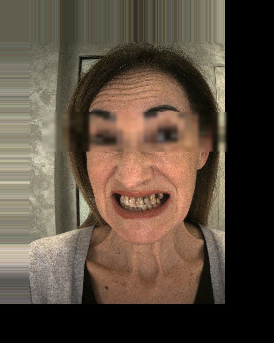 Giuseppa G. prima del trattamento - Sorriso Sicuro